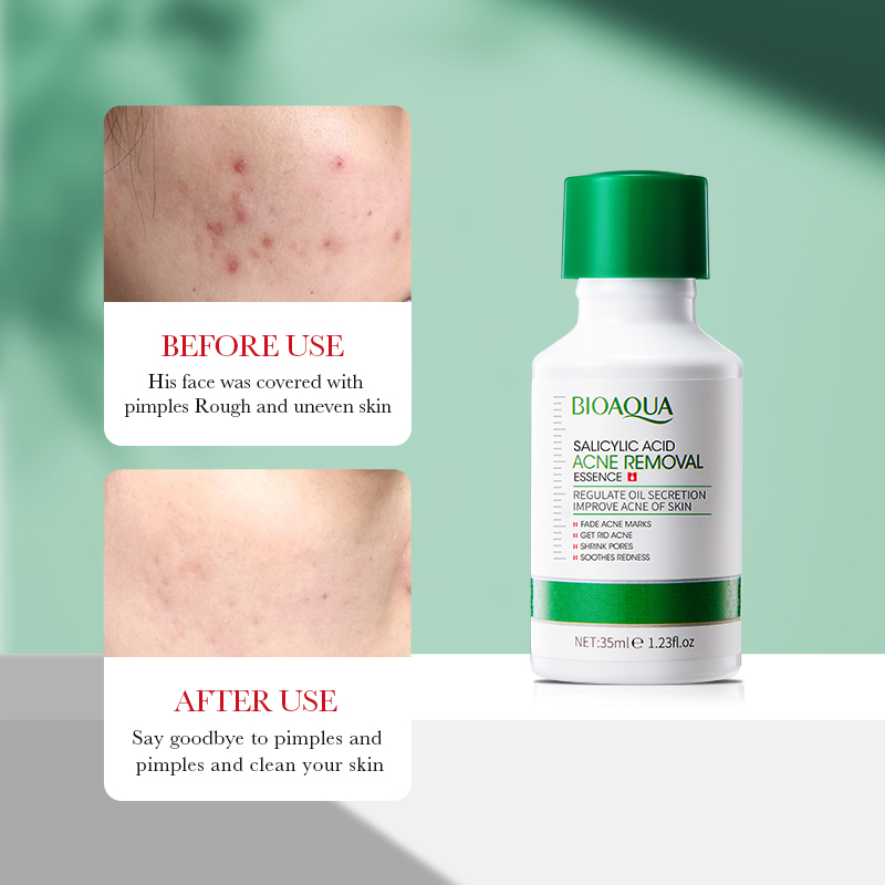 35ml BIOAOUA 살리실산 여드름 제거 에센스 오 - Salicylic Acid Blackhead Remover 리뷰 및 가격