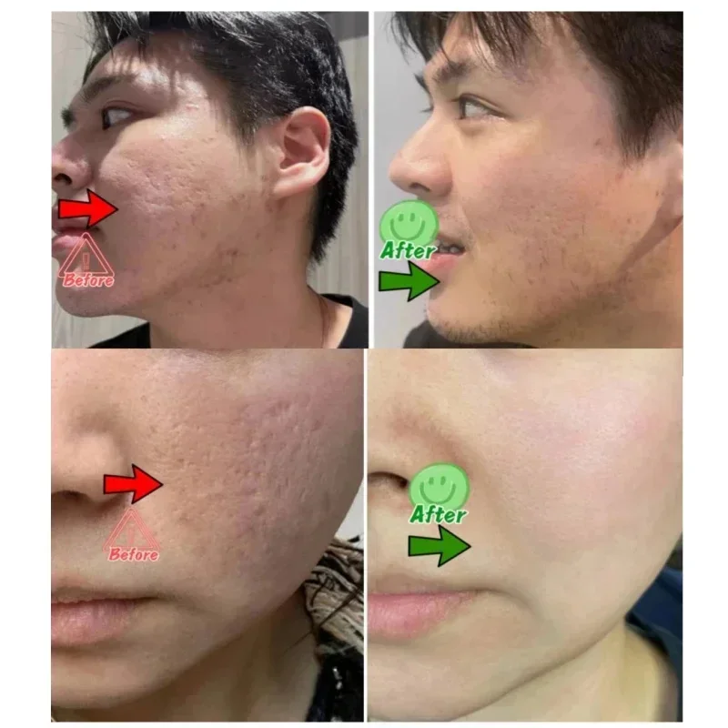 살리실산 모공 클리어링 크림 모공 축소 블랙헤드 제거  - Salicylic Acid Blackhead Remover 리뷰 및 가격