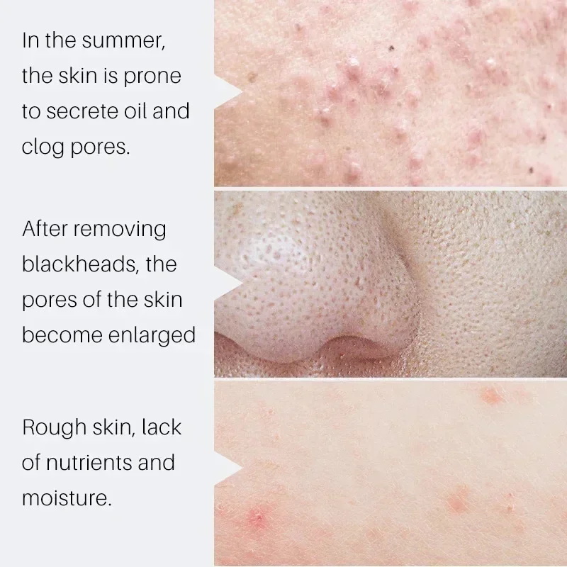 살리실산 모공 축소 세럼 빠른 모공 개선 블랙헤드, 여 - Salicylic Acid Blackhead Remover 리뷰 및 가격