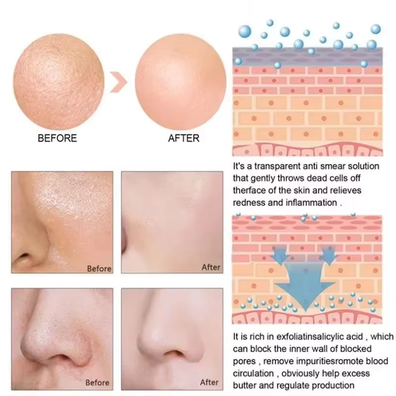 살리실산 모공 축소 세럼 빠른 모공 개선 블랙헤드, 여 - Salicylic Acid Blackhead Remover 리뷰 및 가격