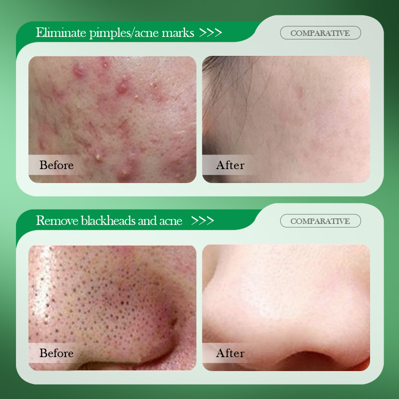 살리실산 여드름 치료 크림, 여드름 자국 개선, 블랙헤 - Salicylic Acid Blackhead Remover 리뷰 및 가격